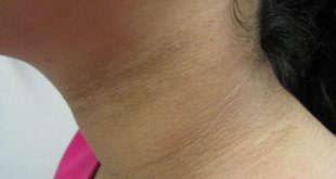 remove black spots on the neck